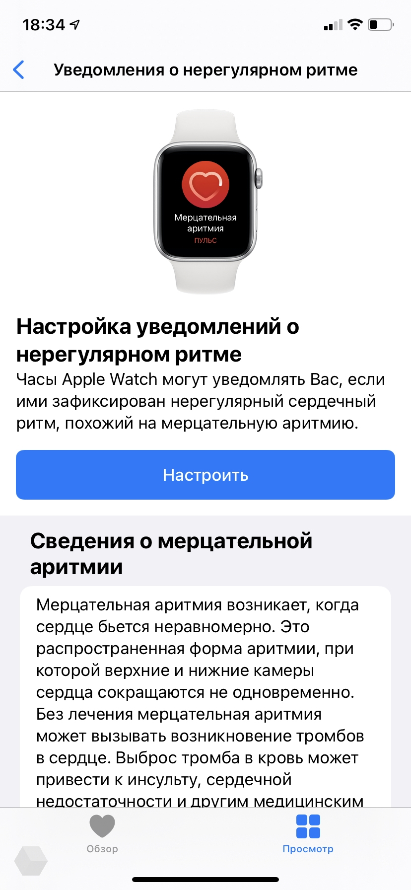 Мерцательная аритмия